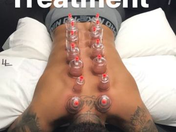 Neymar recibiendo el método del 'Cupping'