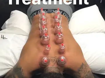 Neymar recibiendo el método del 'Cupping' Neymar recibiendo el método del 'Cupping'