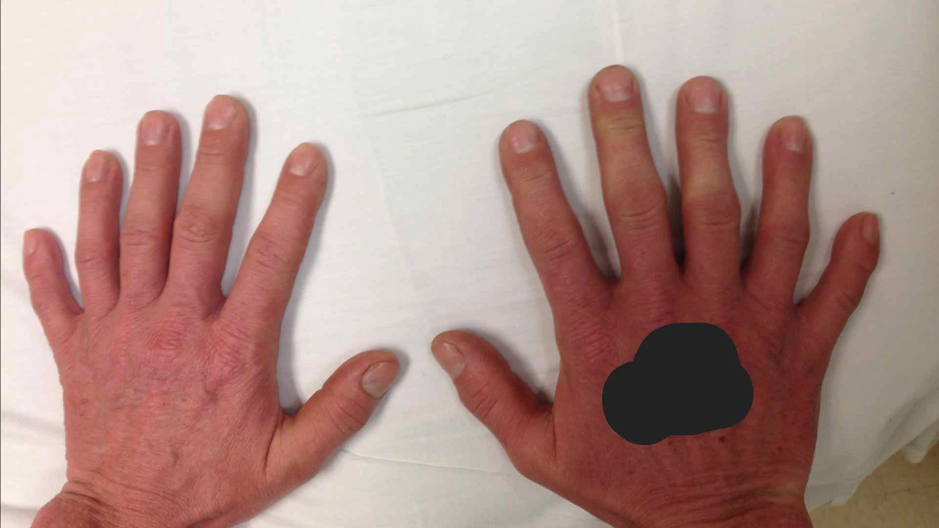 Manos con seis dedos Manos con seis dedos