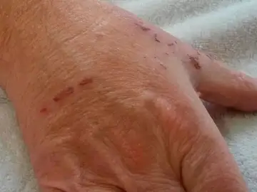 La mujer mordió al hombre en la mano dejándole marcas La mujer mordió al hombre en la mano dejándole marcas