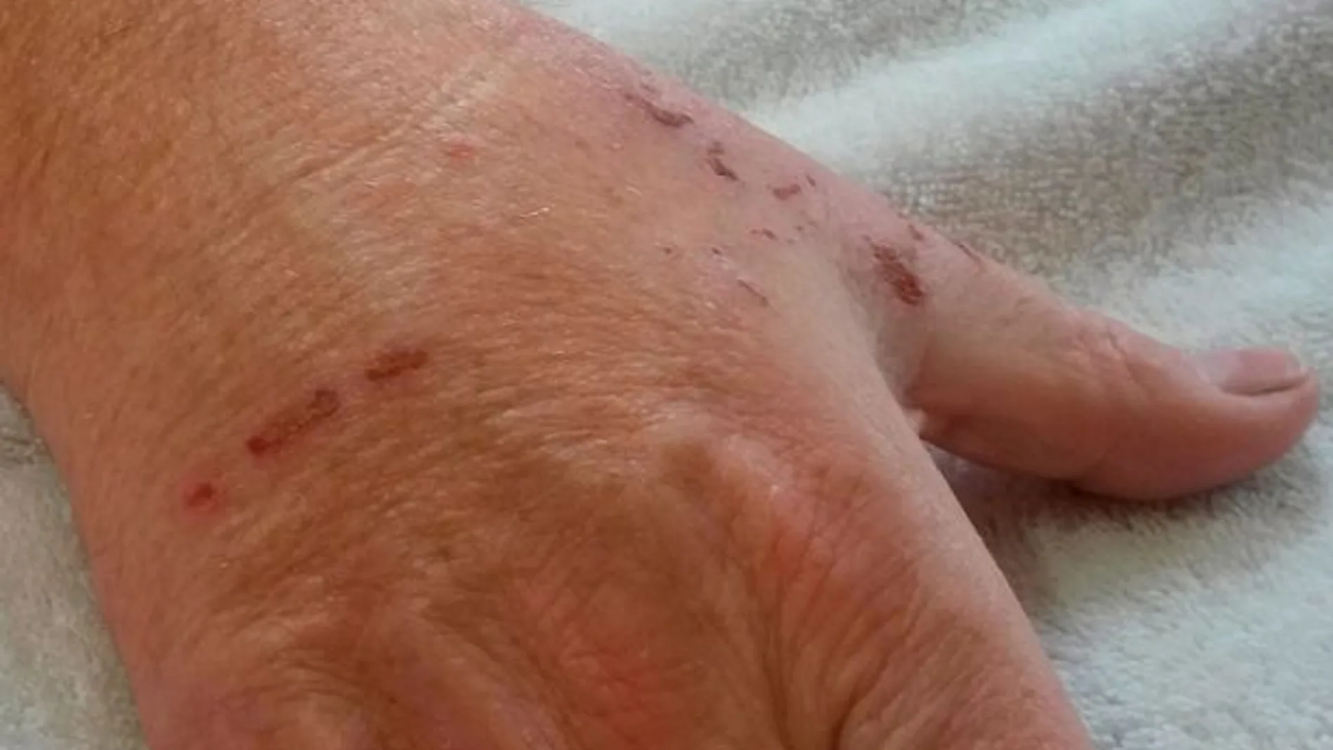 La mujer mordió al hombre en la mano dejándole marcas La mujer mordió al hombre en la mano dejándole marcas