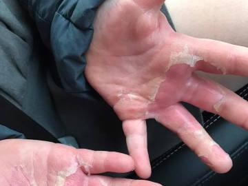 Las manos de una niña, quemadas por jugar con una pasta casera