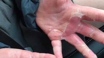 Las manos de una niña, quemadas por jugar con una pasta casera