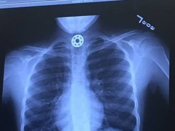 Radiografía de la niña que muestra el Fidget Spinner