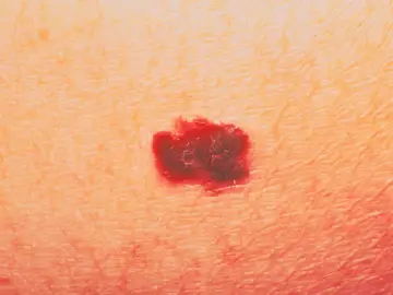 Melanoma Melanoma