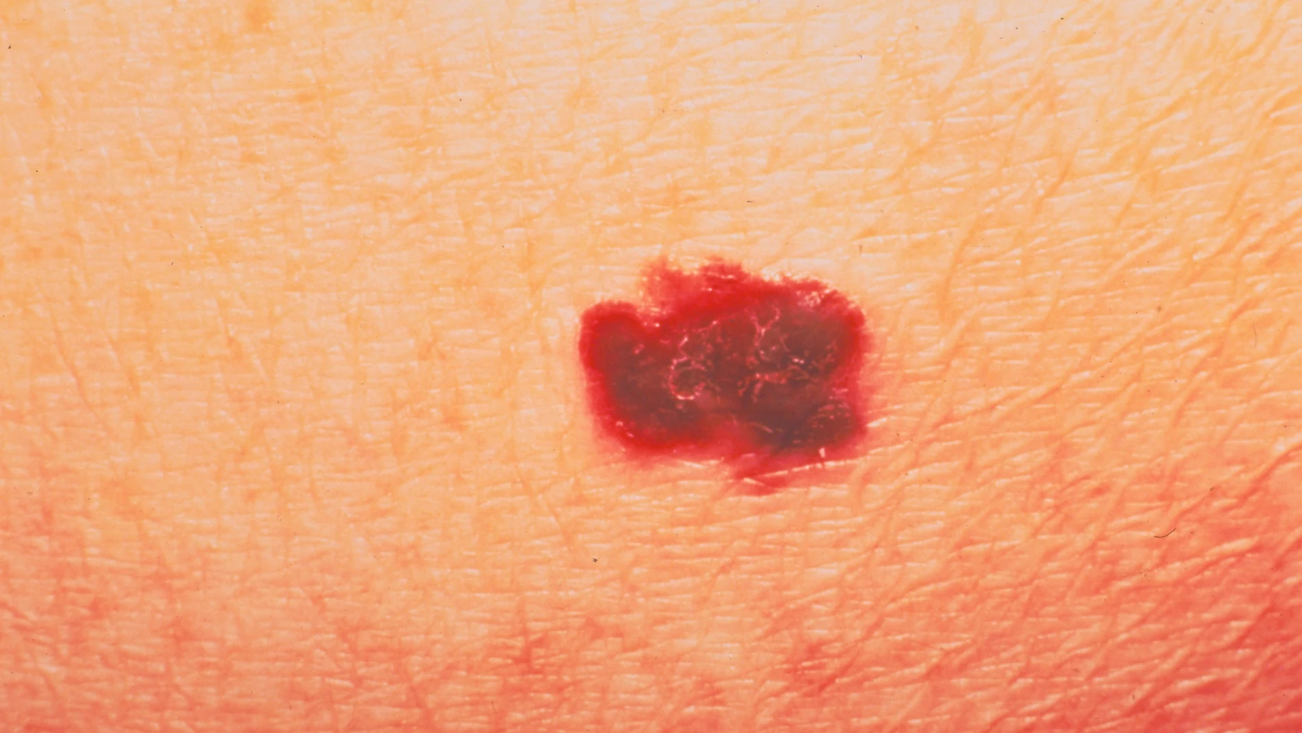 Melanoma Melanoma