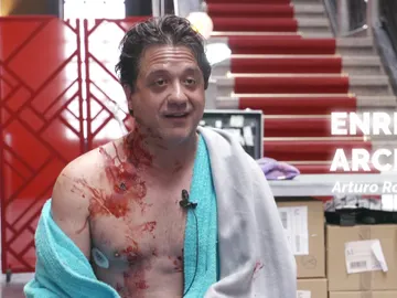 Enrique Arce confiesa haber recibido puntos reales en la piel durante el rodaje de su operación Enrique Arce confiesa haber recibido puntos reales en la piel durante el rodaje de su operación