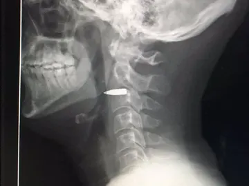 Una bala perdida impacta en el cuello de un reportero sin causarle daños Una bala perdida impacta en el cuello de un reportero sin causarle daños