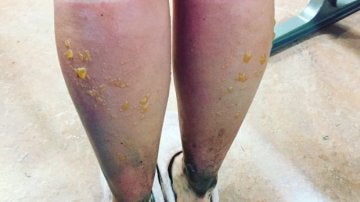 Las consecuencias de las graves quemaduras en las piernas