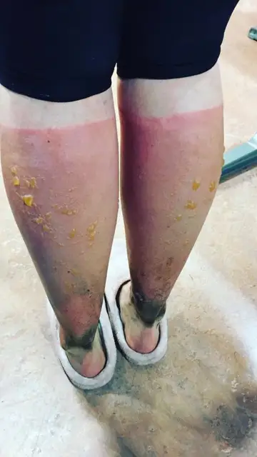 Las consecuencias de las graves quemaduras en las piernas Las consecuencias de las graves quemaduras en las piernas