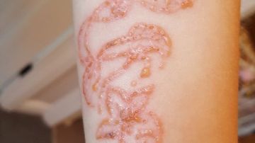 Se hace un tatuaje de henna y acaba con quemaduras 
