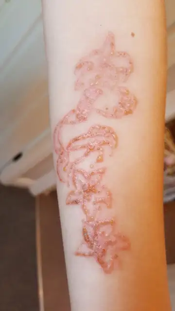 Se hace un tatuaje de henna y acaba con quemaduras Se hace un tatuaje de henna y acaba con quemaduras