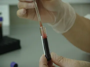 Un análisis de sangre permitiría detectar si tienes cáncer de páncreas y pancreatitis Un análisis de sangre permitiría detectar si tienes cáncer de páncreas y pancreatitis