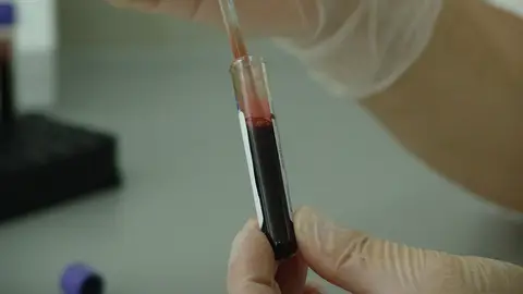 Un análisis de sangre permitiría detectar si tienes cáncer de páncreas y pancreatitis Un análisis de sangre permitiría detectar si tienes cáncer de páncreas y pancreatitis