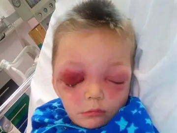 Un niño de cuatro años infectado por la bacteria come carne Un niño de cuatro años infectado por la bacteria come carne