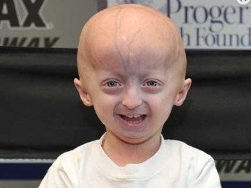 Afectado de progeria