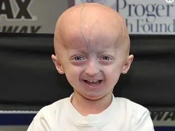 Afectado de progeria Afectado de progeria