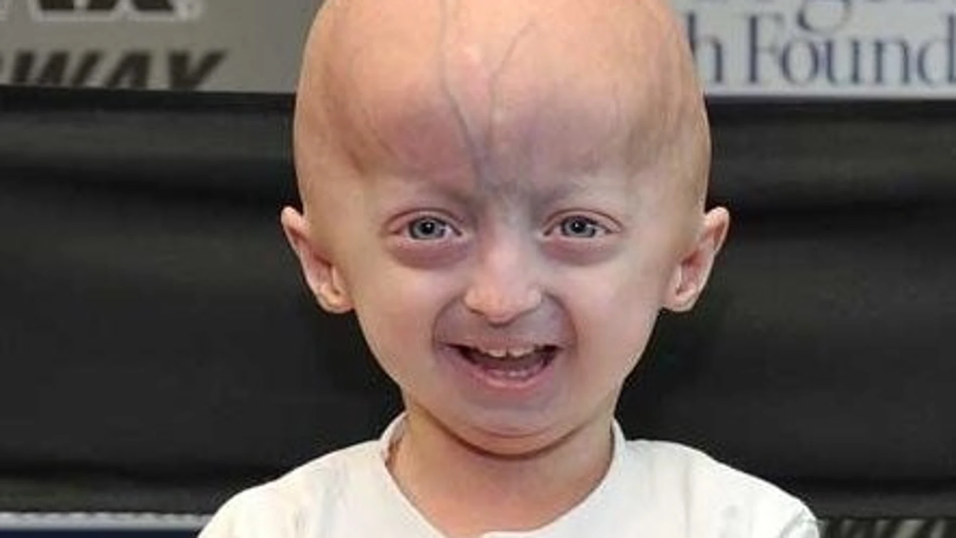 Afectado de progeria Afectado de progeria