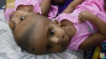 Dos niñas siamesas unidas por la cabeza Dos niñas siamesas unidas por la cabeza