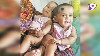Separan con éxito a unas gemelas bangladesíes de diez meses unidas por el recto y la columna