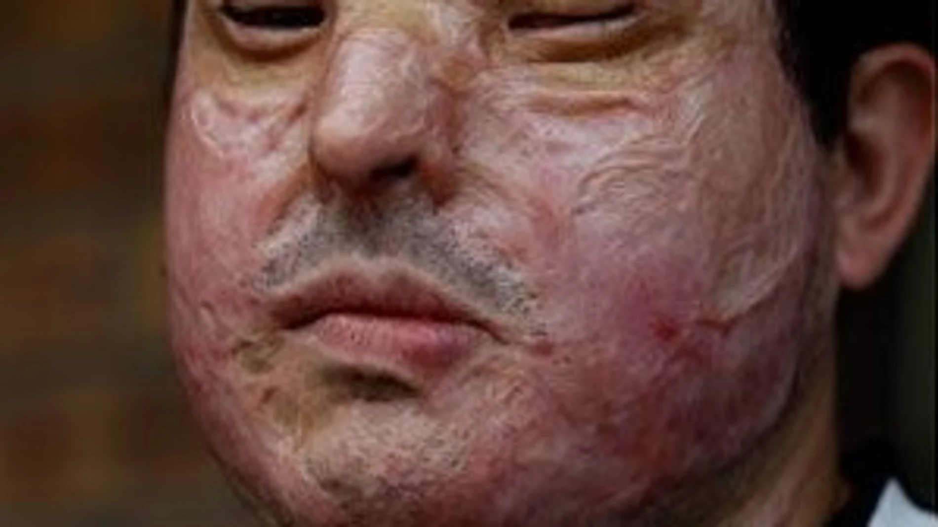 El antes y el después de la víctima del ataque de ácido El antes y el después de la víctima del ataque de ácido