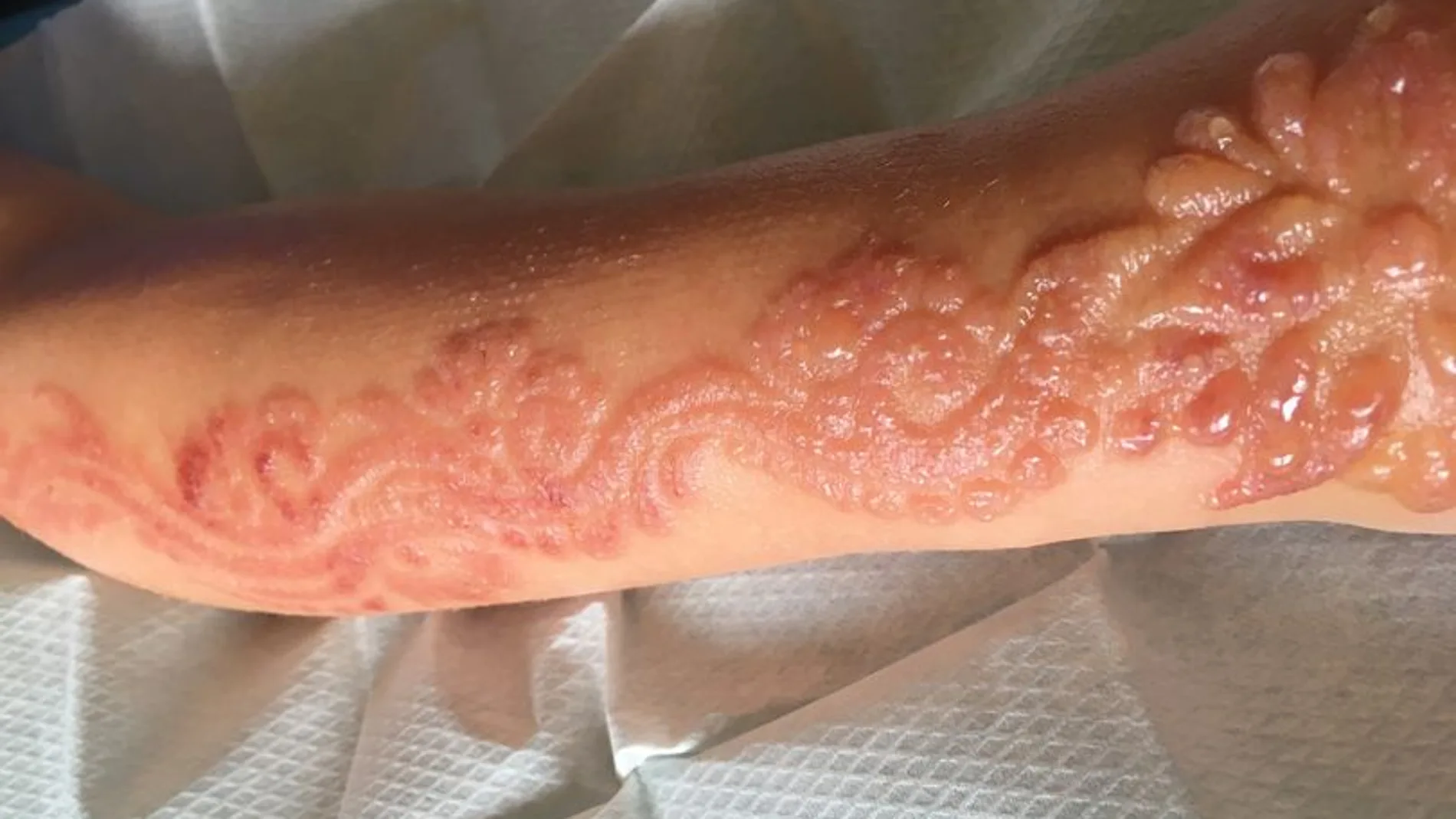 Quemaduras producidas a una niña de siete años por una tatuaje de henna Quemaduras producidas a una niña de siete años por una tatuaje de henna