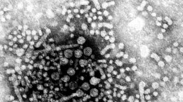 Hepatitis A