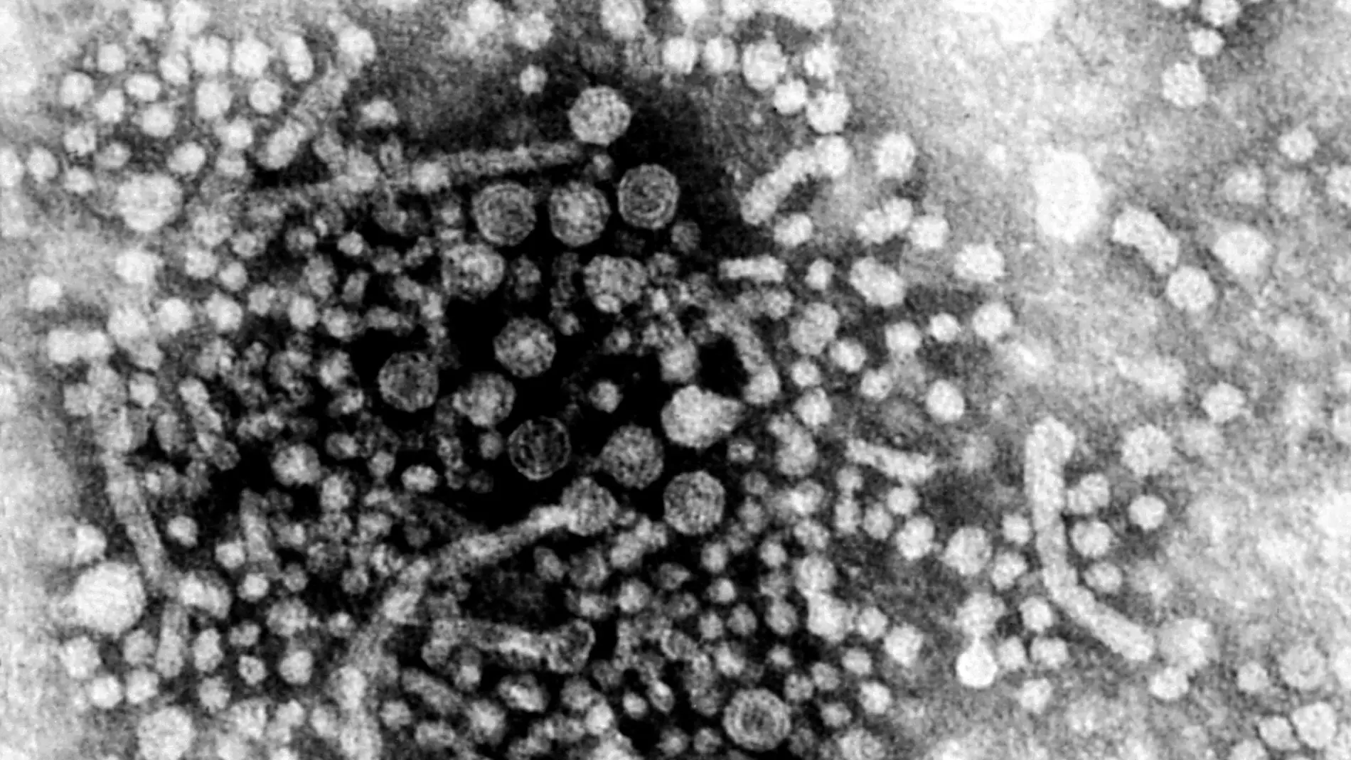 Hepatitis A Hepatitis A