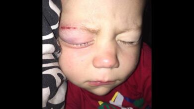 Un bebé de un año vuelve del hospital con los ojos pegados con pegamento