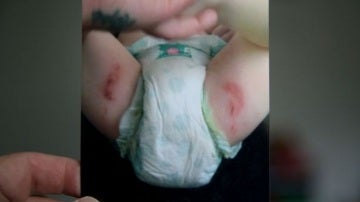 Lesiones abrasivas del bebé