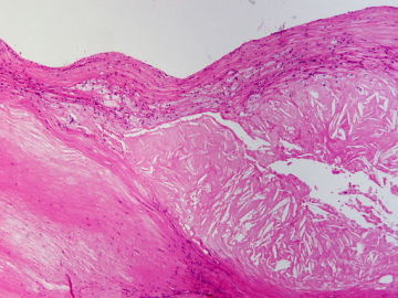 Rellenan celulas con colesterol para el estudio de la aterosclerosis