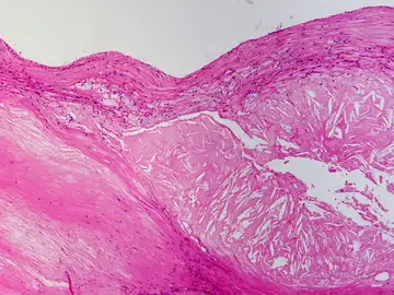 Rellenan celulas con colesterol para el estudio de la aterosclerosis Rellenan celulas con colesterol para el estudio de la aterosclerosis