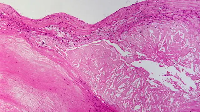 Rellenan celulas con colesterol para el estudio de la aterosclerosis