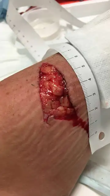 Así quedó su brazo tras sufrir un mordisco Así quedó su brazo tras sufrir un mordisco