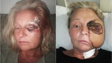 Donna Corden, antes y después de su primera reconstrucción de cara