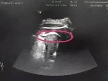 Ecografía del feto Ecografía del feto