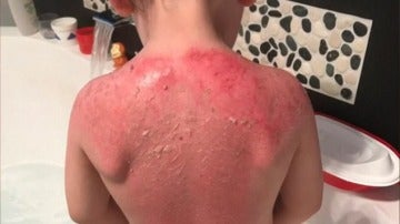 Un niño sufre graves quemaduras