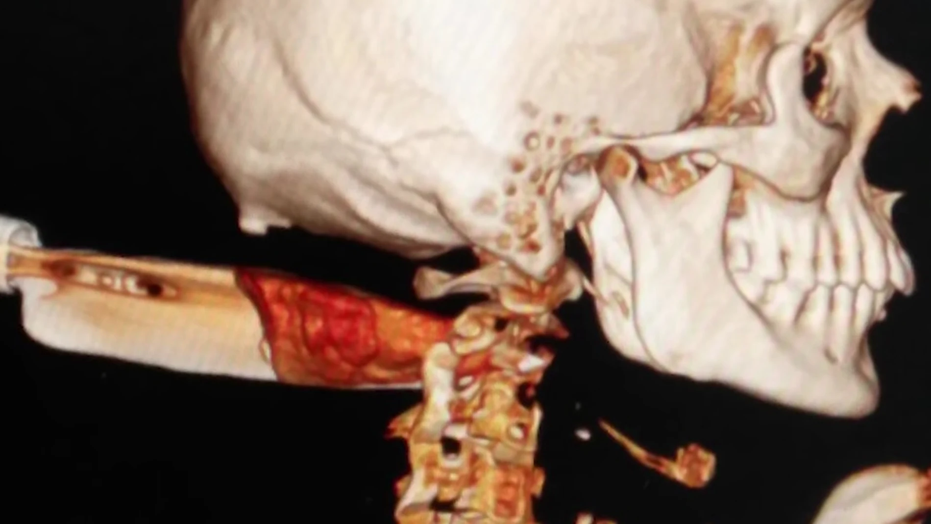 Radiografía de la víctima Radiografía de la víctima