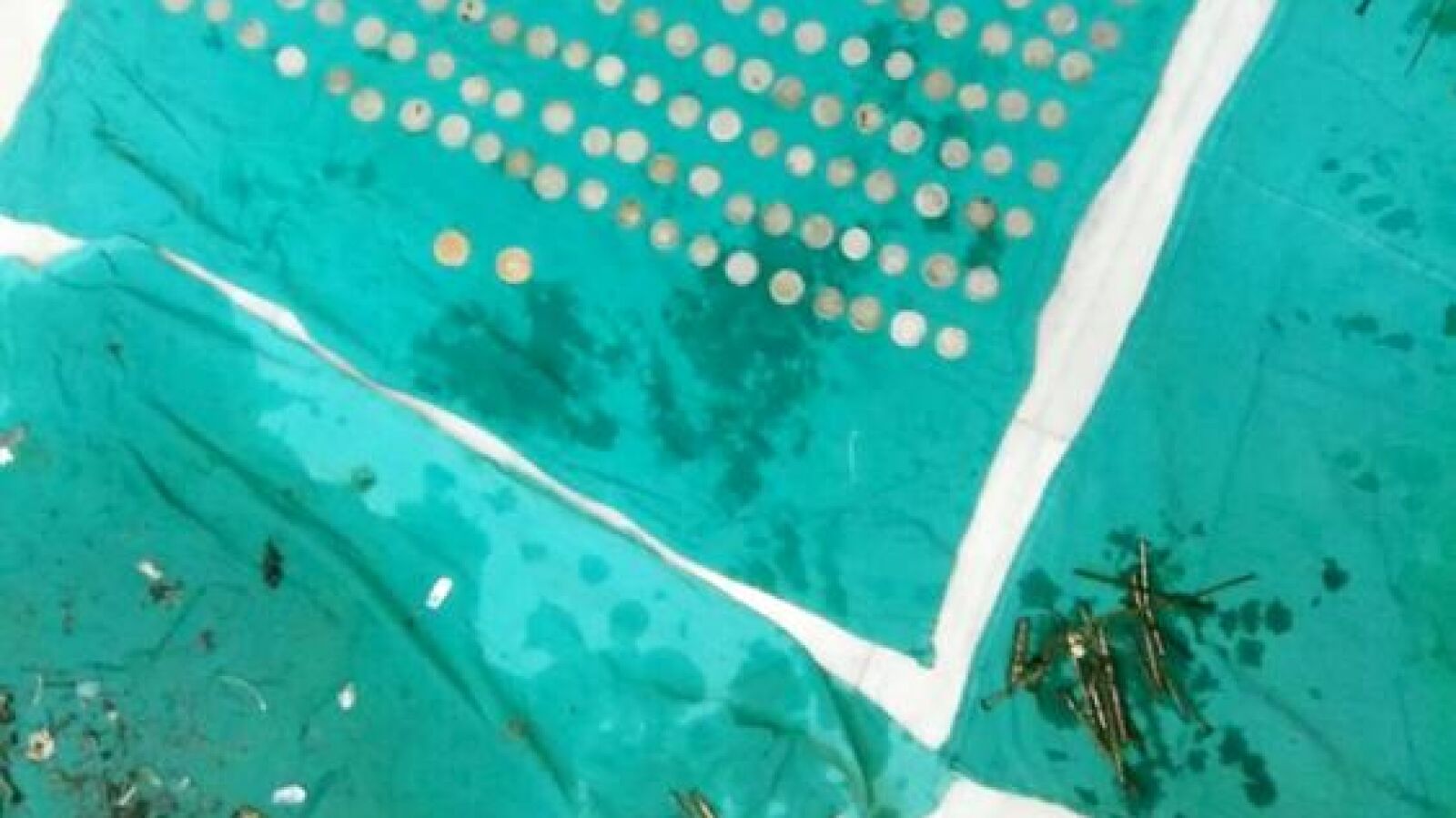 Extraen cientos de monedas y clavos del estómago de un paciente durante una operación