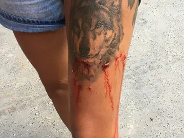 Las heridas causadas por el cocodrilo a la joven británica Las heridas causadas por el cocodrilo a la joven británica