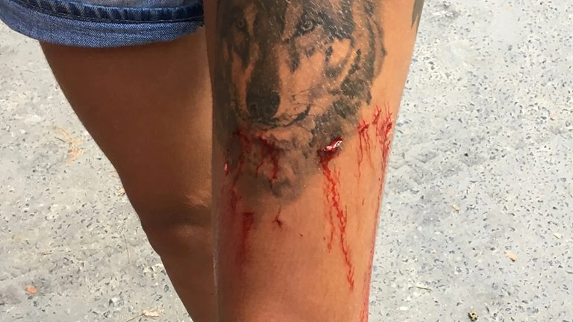 Las heridas causadas por el cocodrilo a la joven británica Las heridas causadas por el cocodrilo a la joven británica