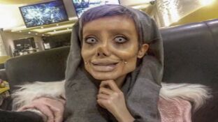 Sahar Tabar, la joven que quer&iacute;a parecerse a Angelina Jolie