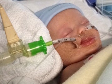 El bebé enfermo de bronquitis en el hospital con un ventilador