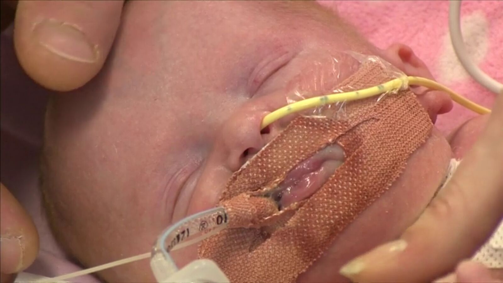 Nace en Reino Unido un bebé con el corazón fuera del pecho