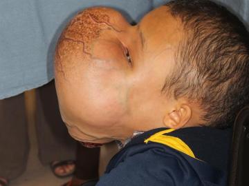 El niño con el tumor facial