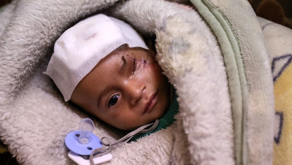 Karim, un niño herido en un bombardeo al este de Al-Guta