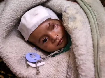 Karim, un niño herido en un bombardeo al este de Al-Guta Karim, un niño herido en un bombardeo al este de Al-Guta