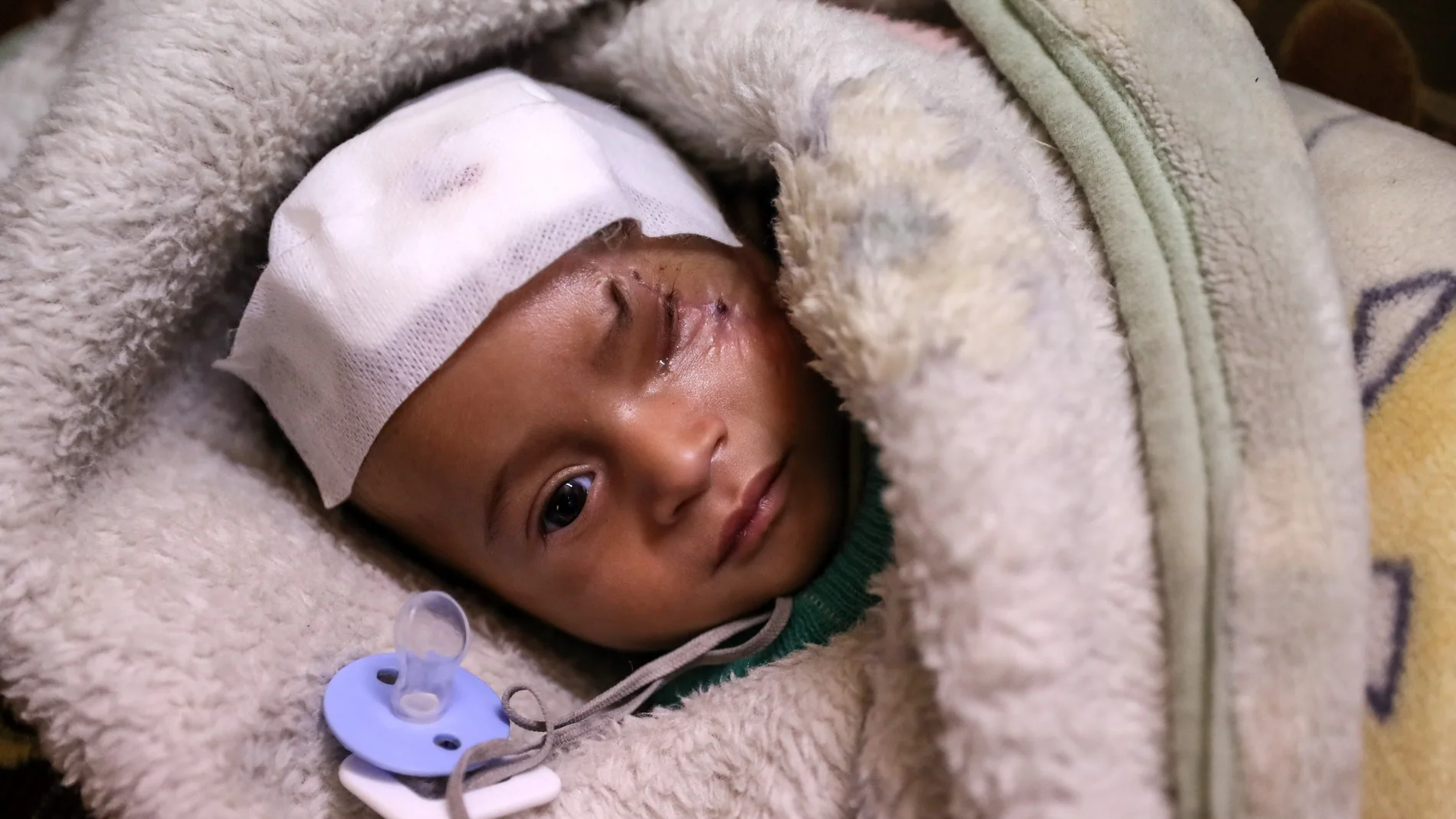 Karim, un niño herido en un bombardeo al este de Al-Guta Karim, un niño herido en un bombardeo al este de Al-Guta