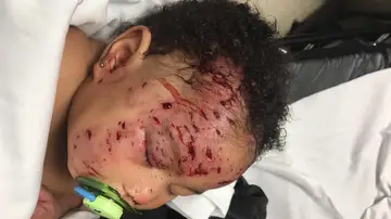 Las heridas que le provocó el mapache Las heridas que le provocó el mapache