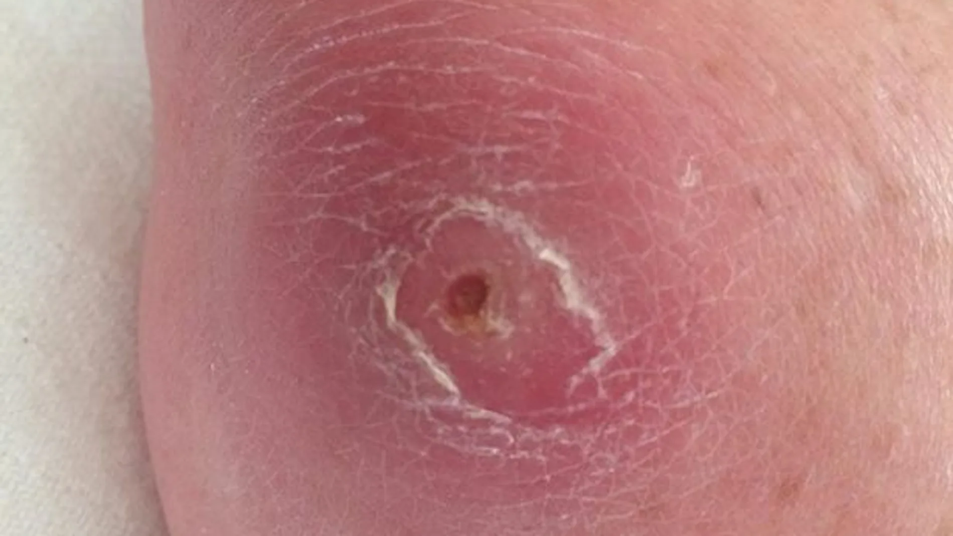 Mancha en el brazo Mancha en el brazo